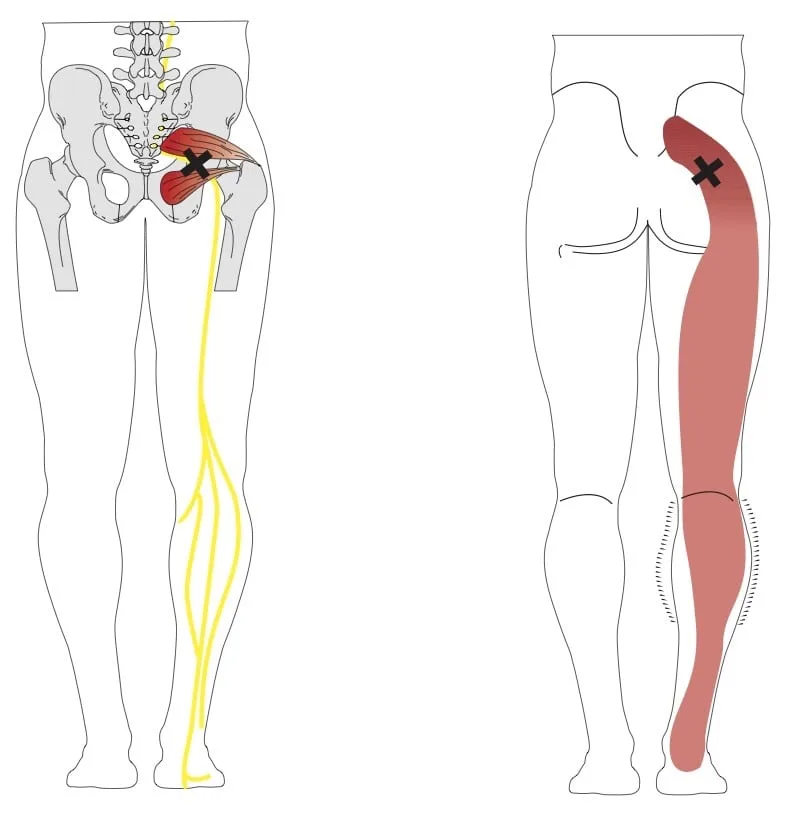 Diagram of the piriformis muscle and its relationship to the sciatic nerve