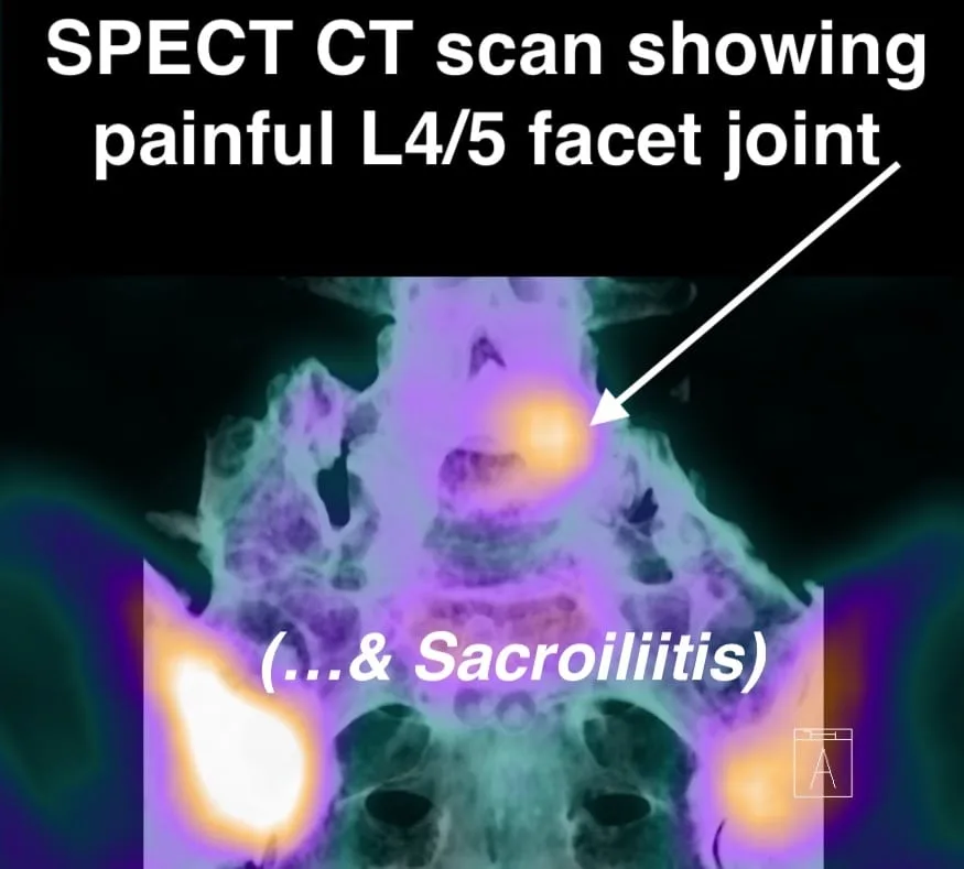 Diagram of the facet joints of the lumbar spine