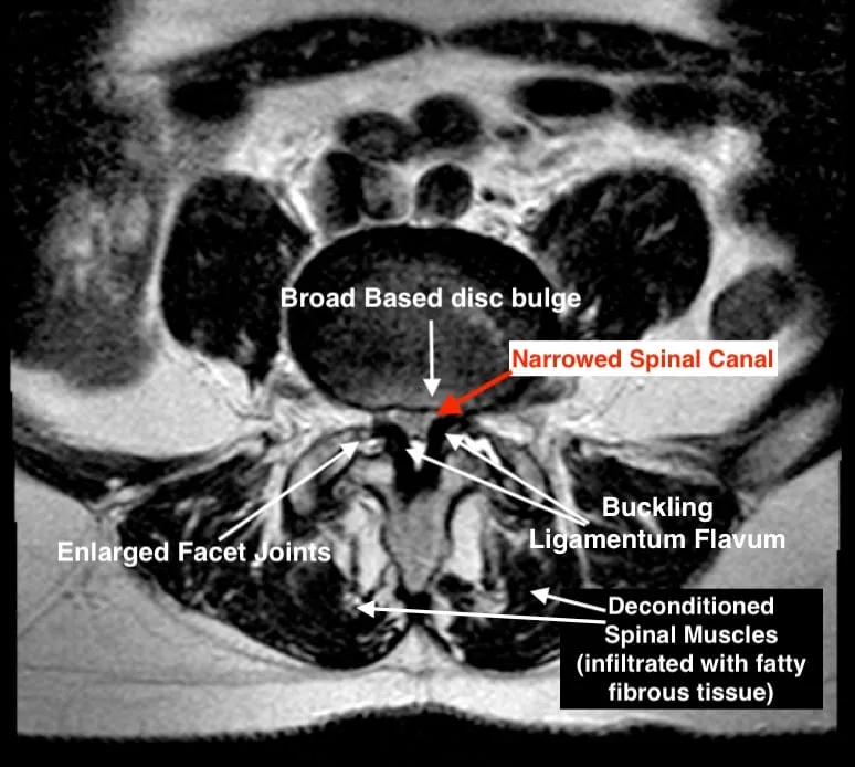 Diagram of spinal stenosis showing narrowing of the spinal canal