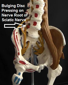Diagram showing a bulging disc pressing on a spinal nerve