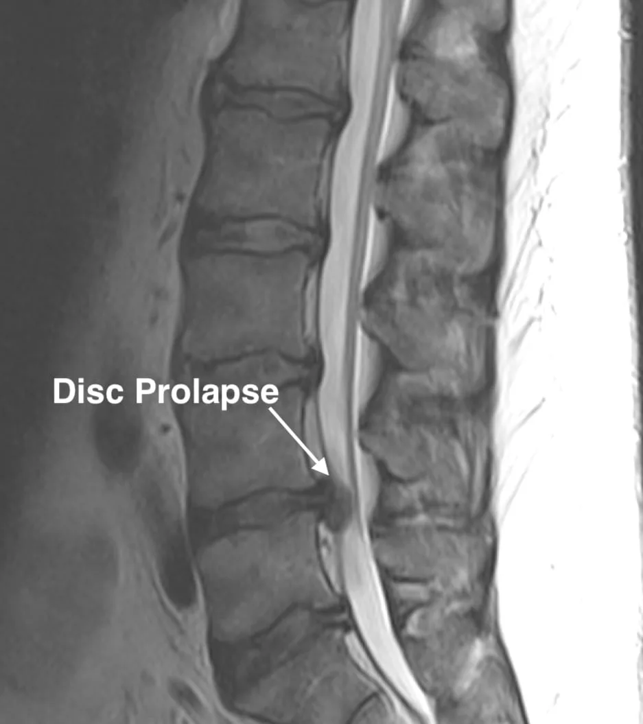Diagram of a bulging and prolapsed spinal disc pressing on a nerve