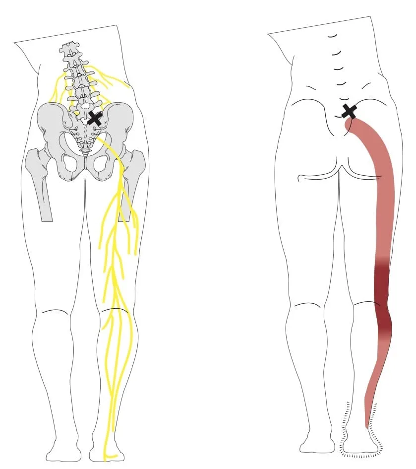 Diagram showing sciatica caused by a disc prolapse pressing on the sciatic nerve