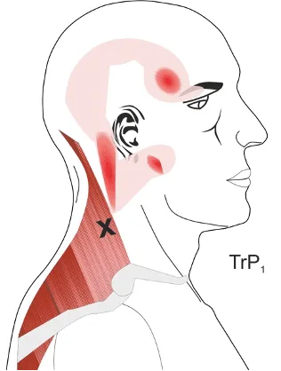 Trapezius trigger point map