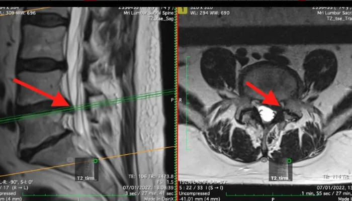 MRI scan lumbar spine stenosis