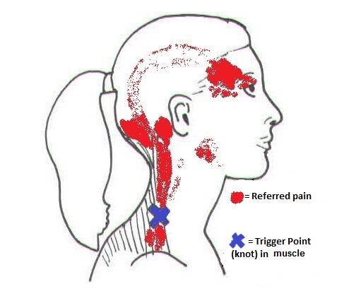 Traps Trigger Point illustration 4