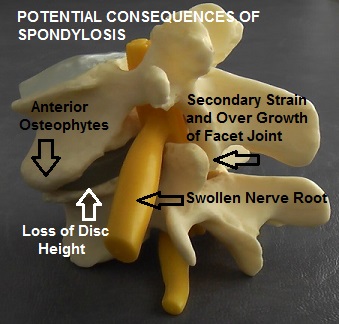 Anterior_Osteophytes