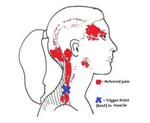 Neck Pain And Headaches Spine Plus