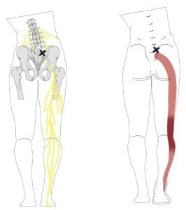 4_Sciatica_from_disc__prolapse_EPS
