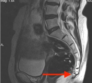 Coccyx