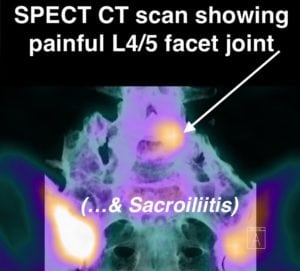 Right SI and left L5-S1 facet