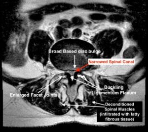 Spinal Stenosis