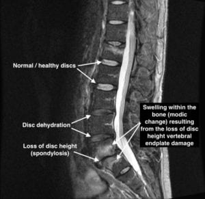 Treatment for Degenerative Disc (spondylosis)