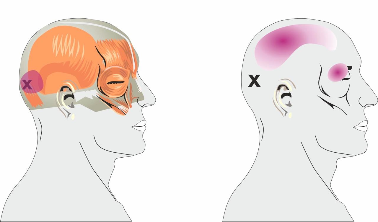 Tension Headaches Spine Plus