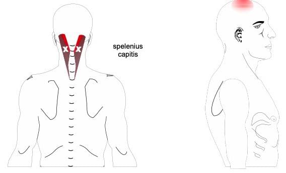 Tension Headaches Spine Plus