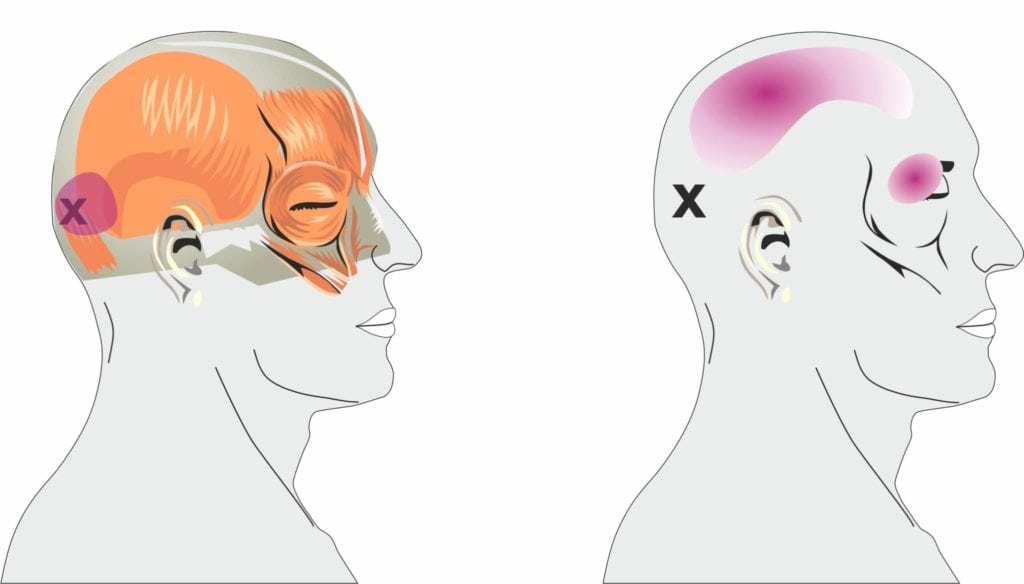 Headaches involving pain over the eye