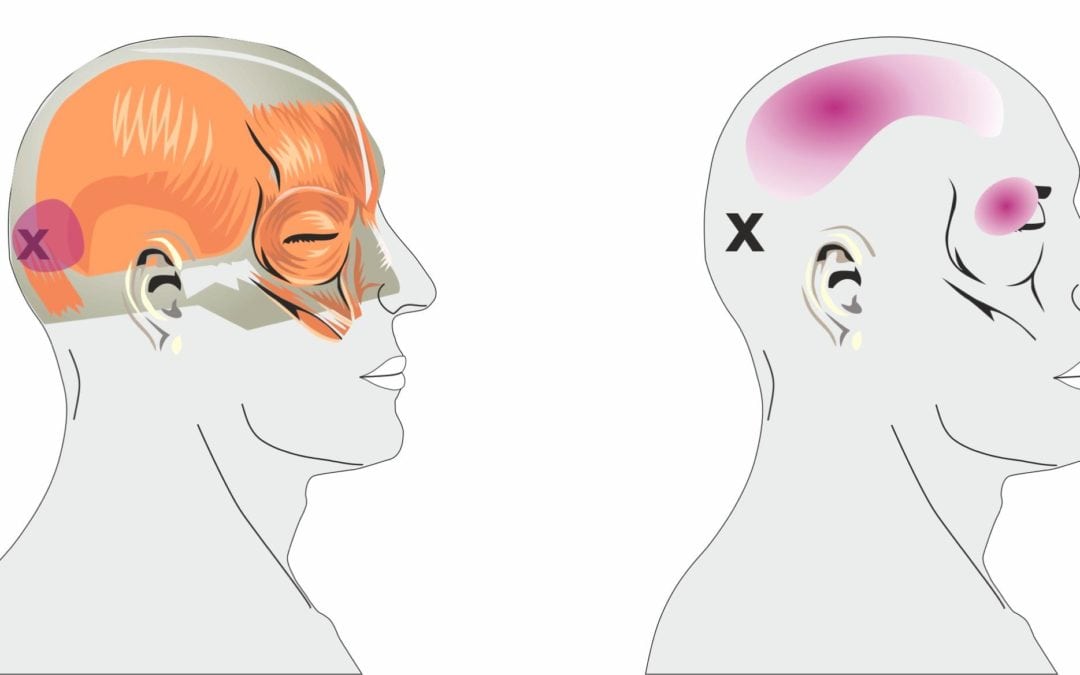 Different Types of Headaches…and How to Help Them
