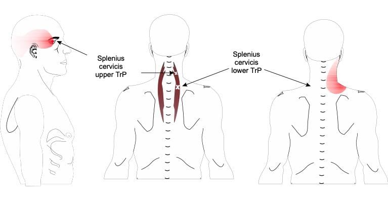 Tension Headaches Spine Plus