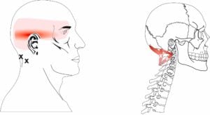 Headaches over the side of the Head