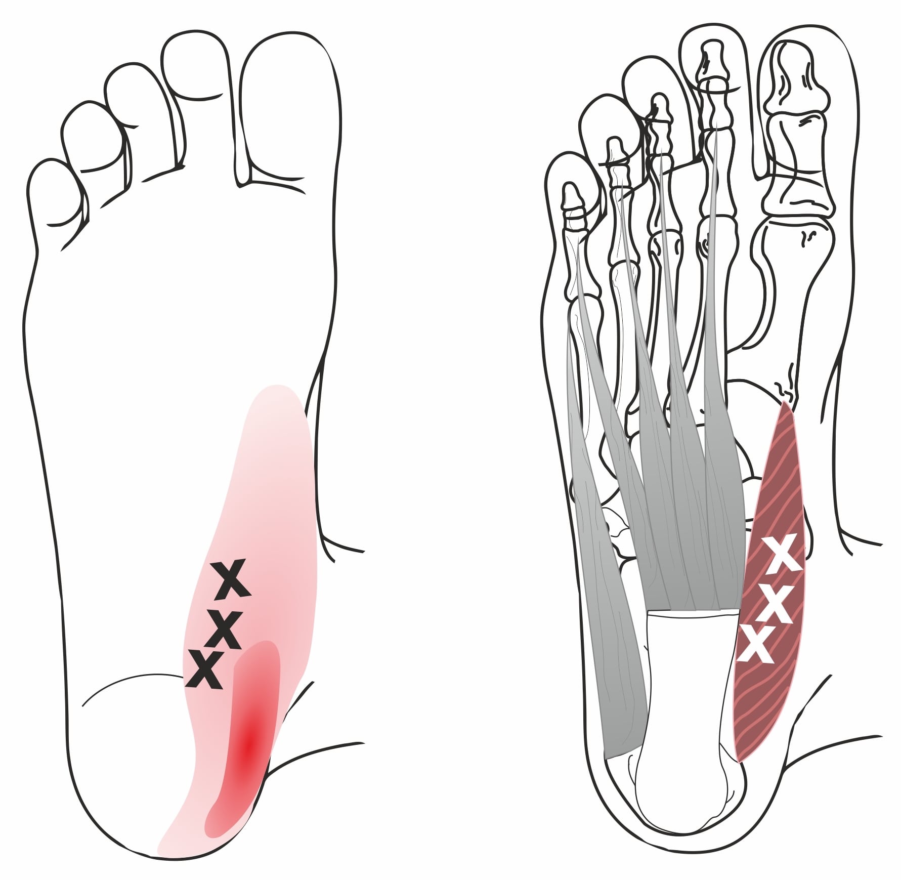 Plantar Fasciitis (Heel Pain, Sole of the Foot Pain, Heel Spur) Treatment