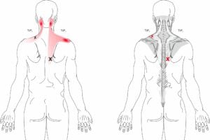 Posterior Headache 2