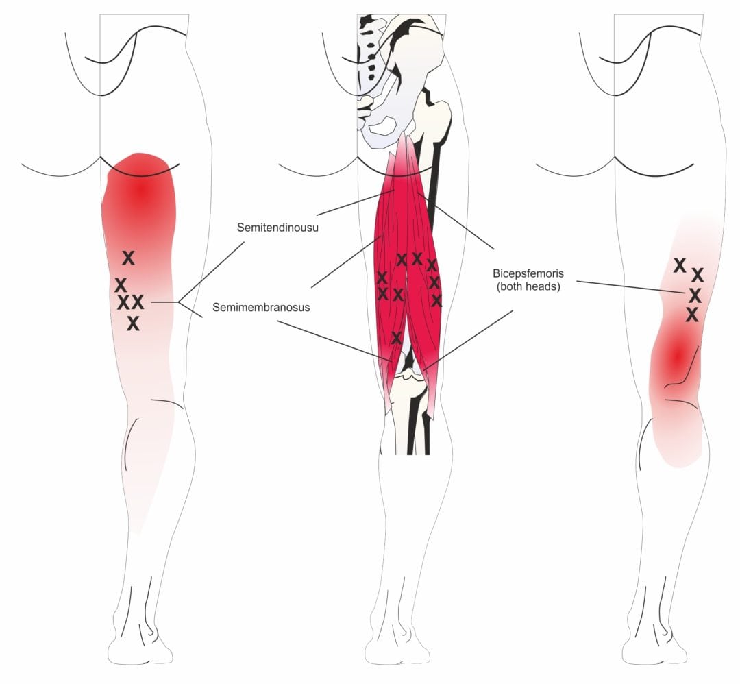 Sports Injuries, Muscle & Other Soft Tissue Pain and Injuries Spine Plus