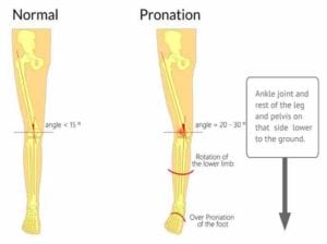 Treatment For Runner’s knee (Patella Femoral Pain)