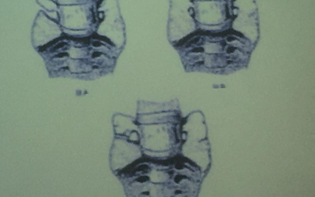 Transitional Lumbosacral Joints