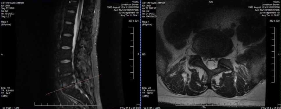 MRI scan of lower back