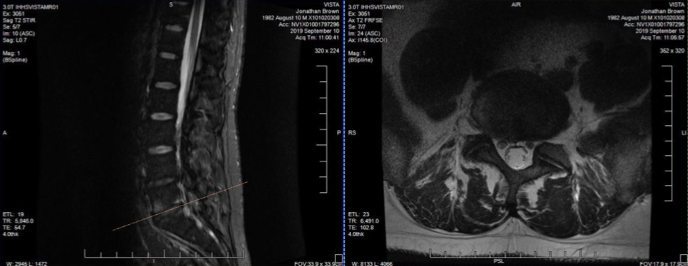 MRI Points the Way to Resolving Jon’s Chronic Low Back Pain