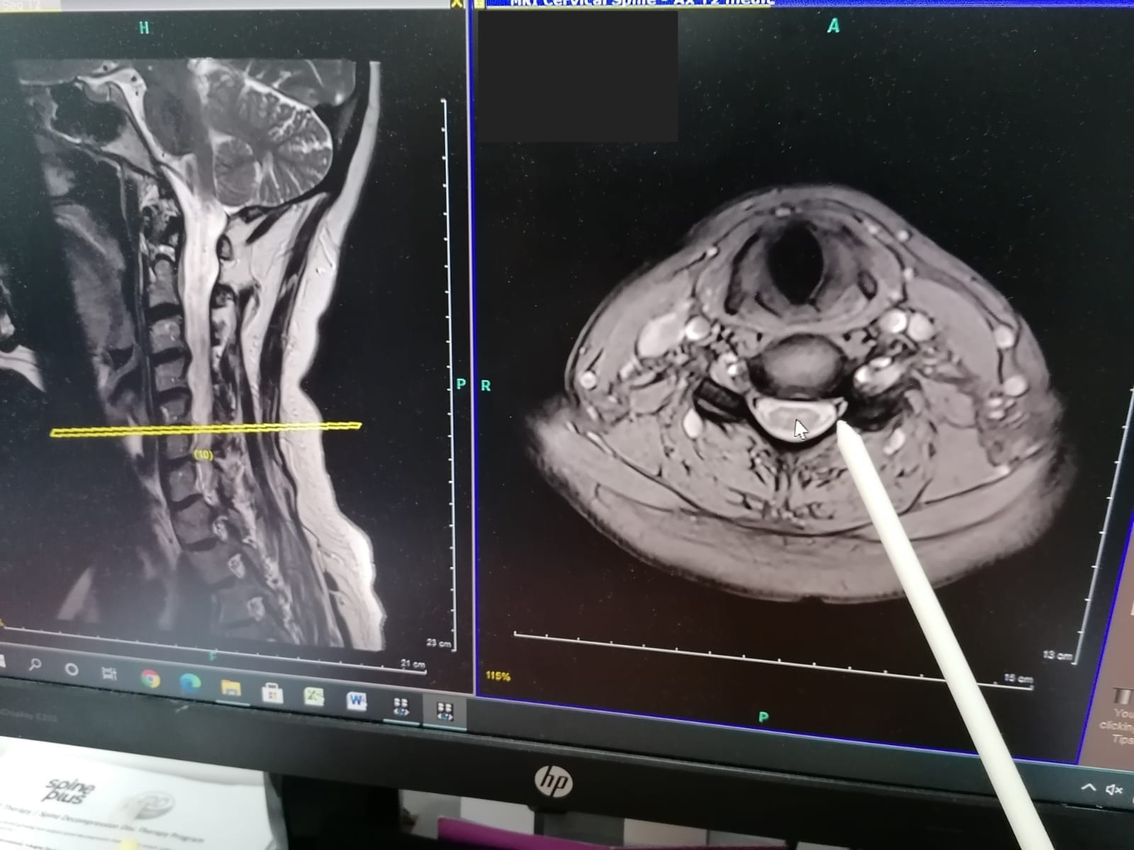 MRI scan of neck