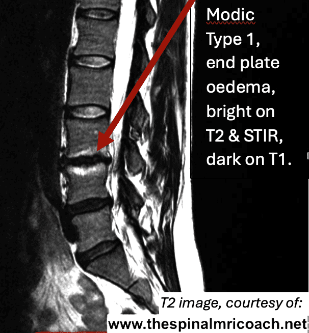 Modic Type 1 and Disc End Plate Changes