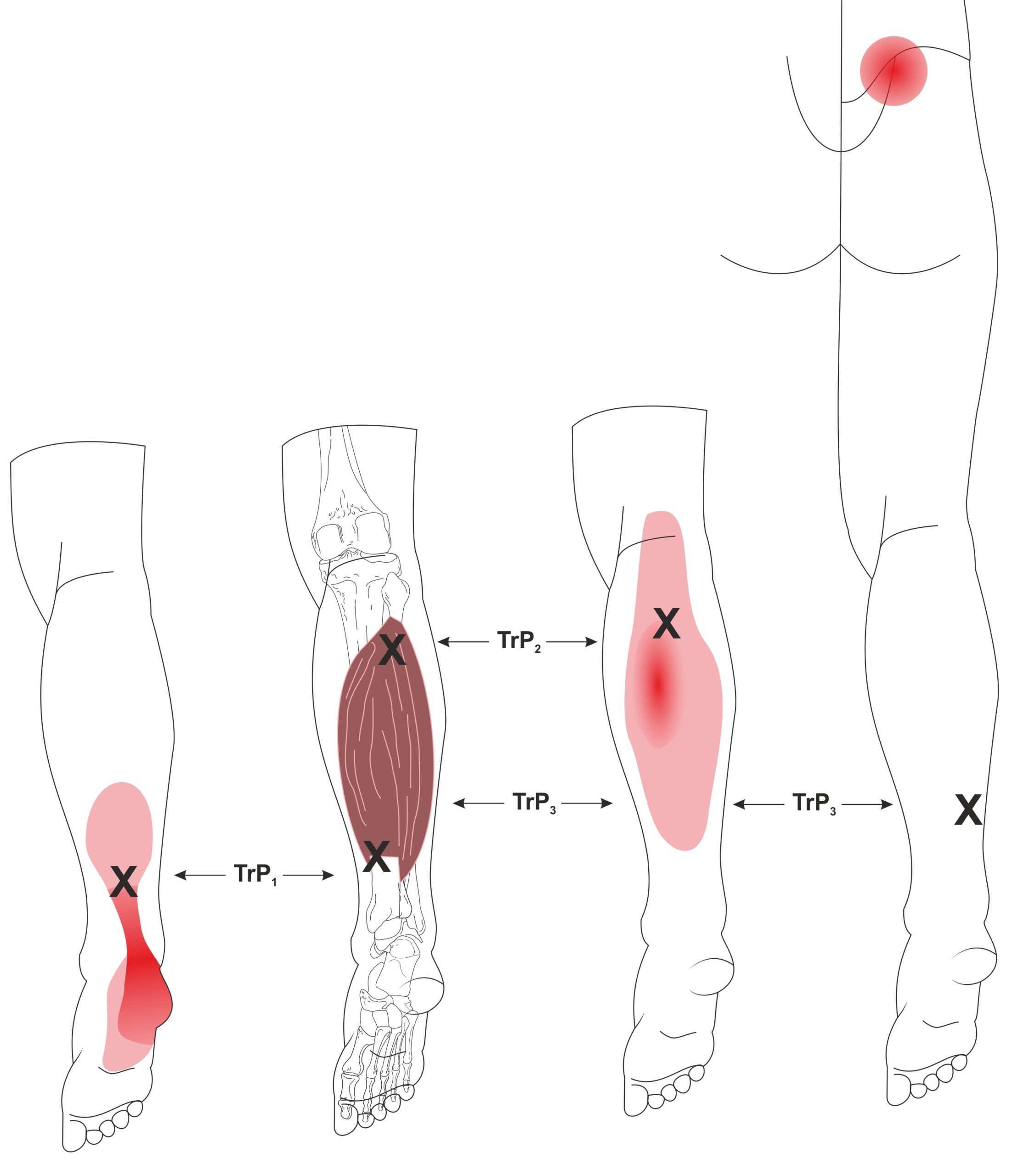 Soleus_Trigger Points Calf Pain and Achilles Trigger Points