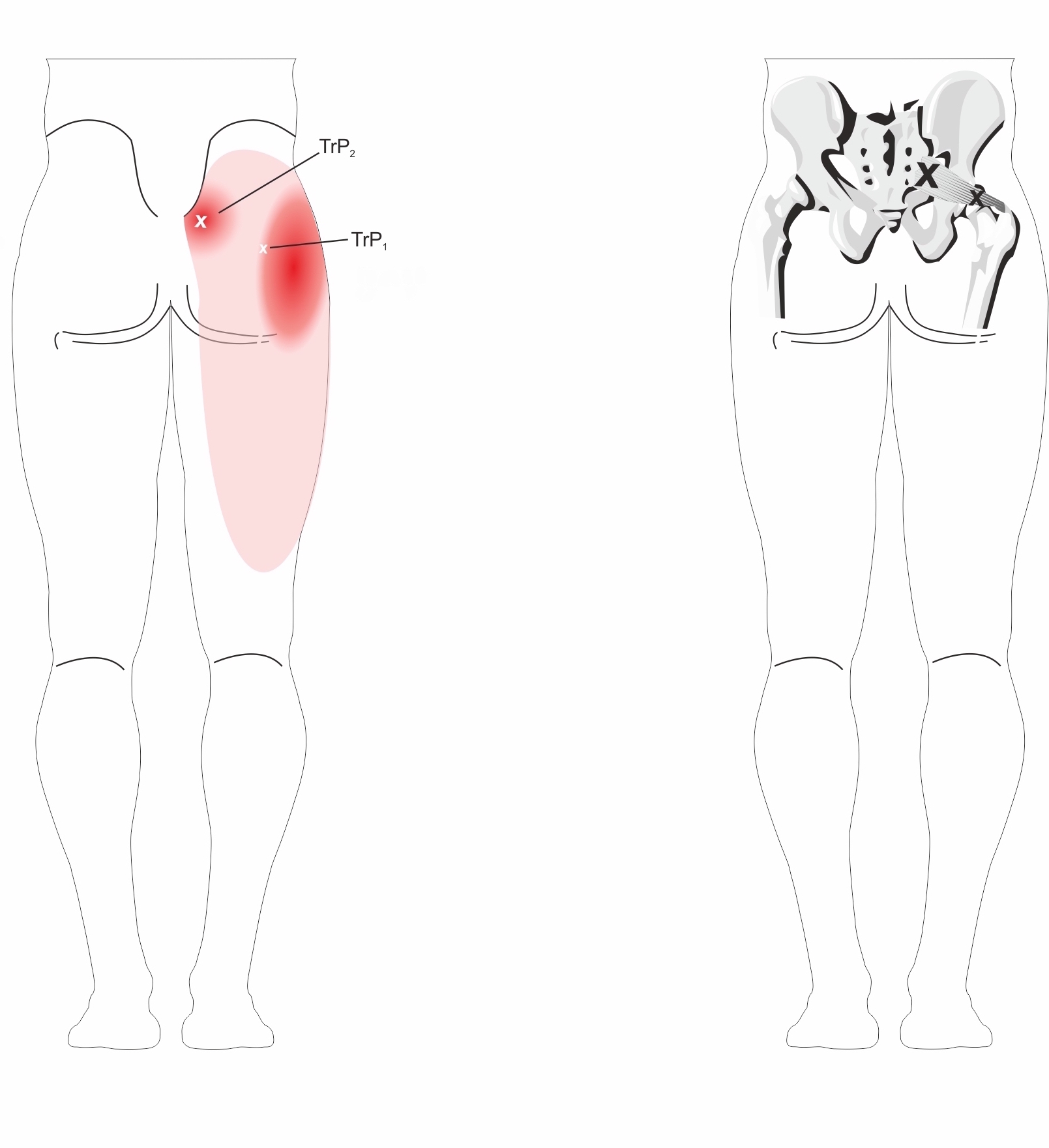 Piriformis Syndrome Treatment